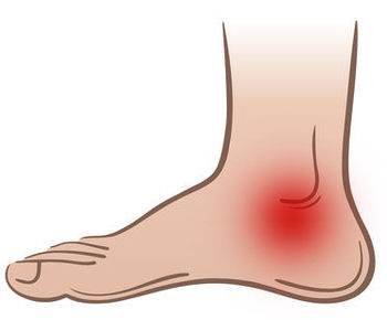 Posterior Tibial Tendon Dysfunction